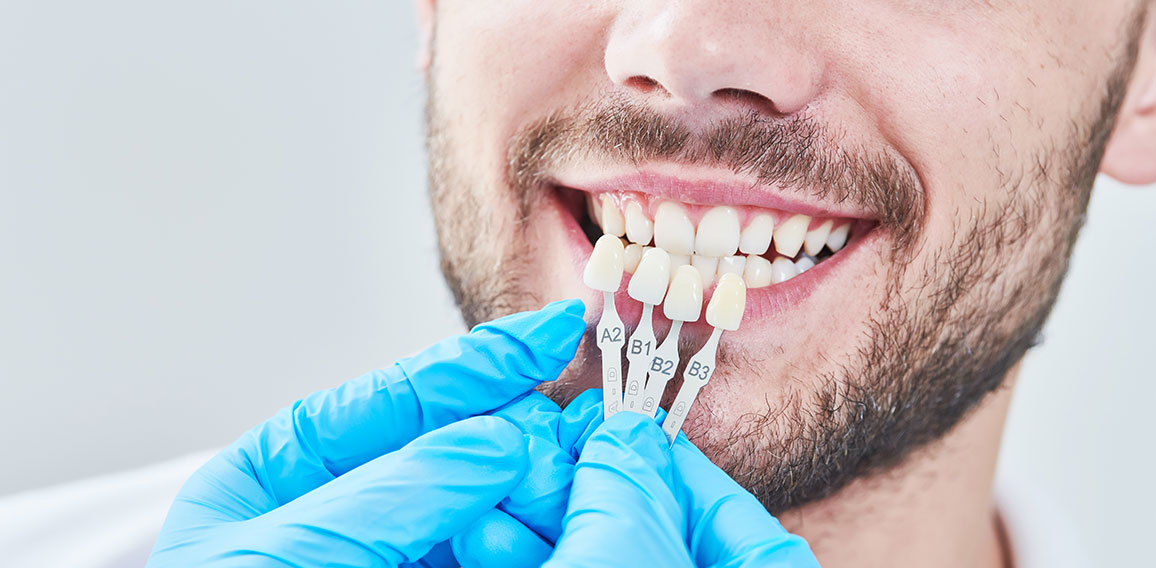 dentistry. matching colour of the tooth enamel with whitening chart