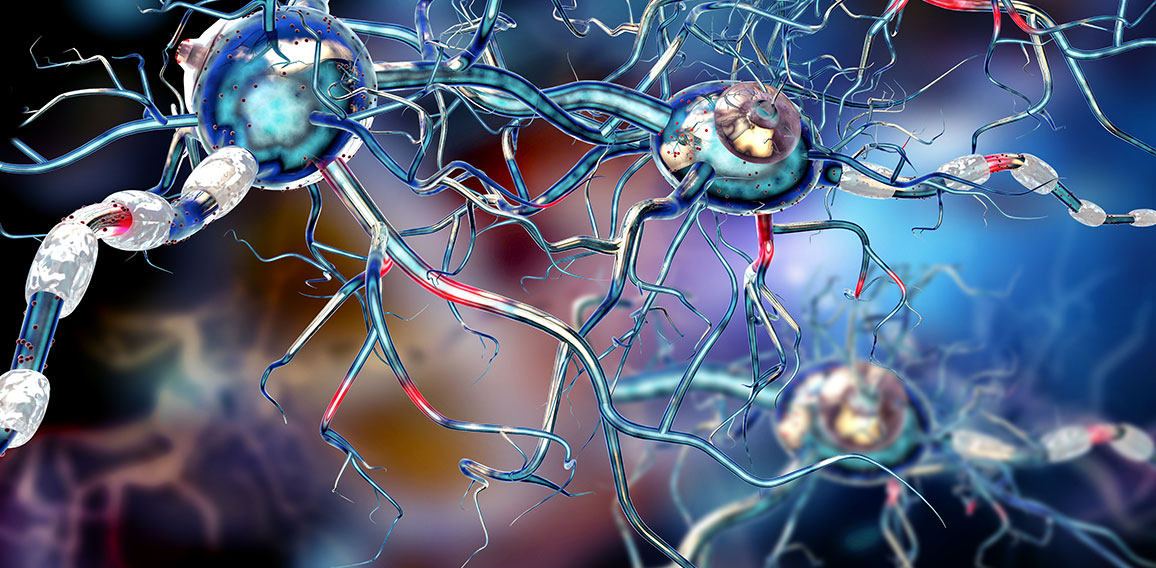 Damaged nerve cells, concept for neurodegenerative and neurologi